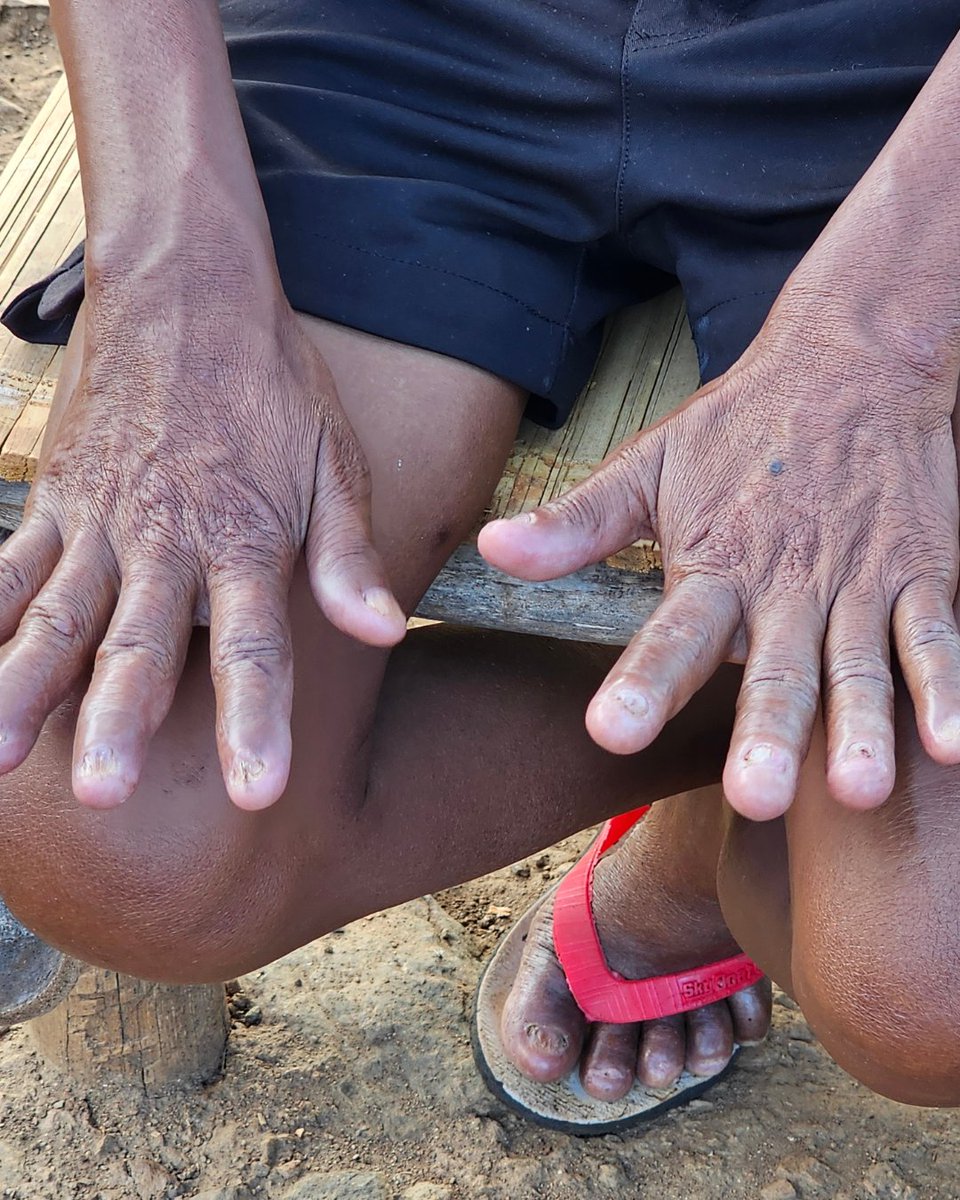 Leprosy Mission Australia tweet media