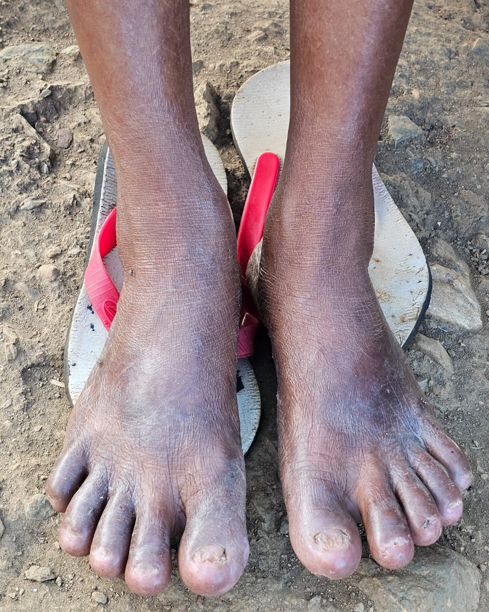 Leprosy Mission Australia tweet media
