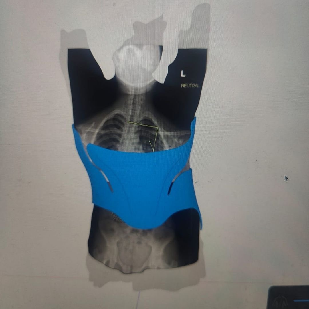 RoverlabsTz's tweet photo. Back pain or poor posture can affect daily life. 

A #SpinalBrace helps support alignment and reduce strain, especially when combined with #Physiotherapy. 

At #RoverlabsTanzania, we design customized spinal braces to support better posture and movement. #BackCare #Orthotics https://t.co/FLM7wZGuwa