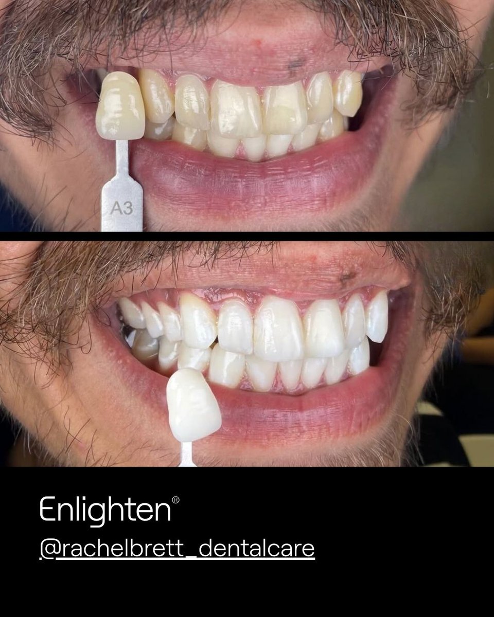 enlightensmiles's tweet photo. Real Results!

This patient of @rachelbrett_dentalcare achieved a few shades lighter than b1 - incredible results! 

Enlighten is designed to deliver predictable, long-lasting results, all in the comfort of your own home!

#enlightensmiles #enlighten #beforeandafterwhitening https://t.co/m4vL32hrxa