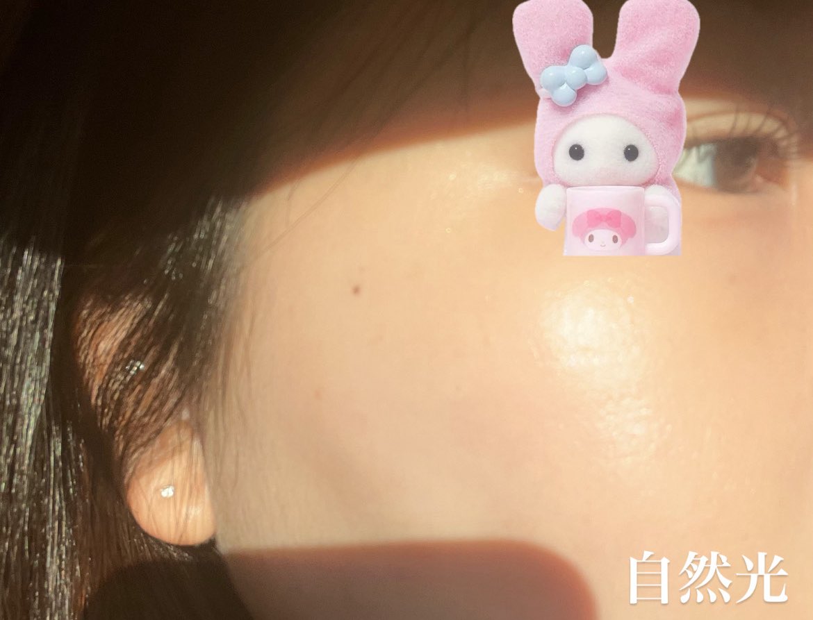 OTTD_ll's tweet photo. テイアクリニック@theiaclinic_jp でジュベルックして約２週間。やっぱ乾燥×毛穴にはジュベルック定期的に打つのが一番いい気がする。Derma：Codeが算出した適切な用量で施術を受けたからより効果が高く感じる💉

唇フィラーは腫れも引いて自然にボリュームでてまさに望んでた唇になって大満足🥹 https://t.co/IYPqLKPbgm