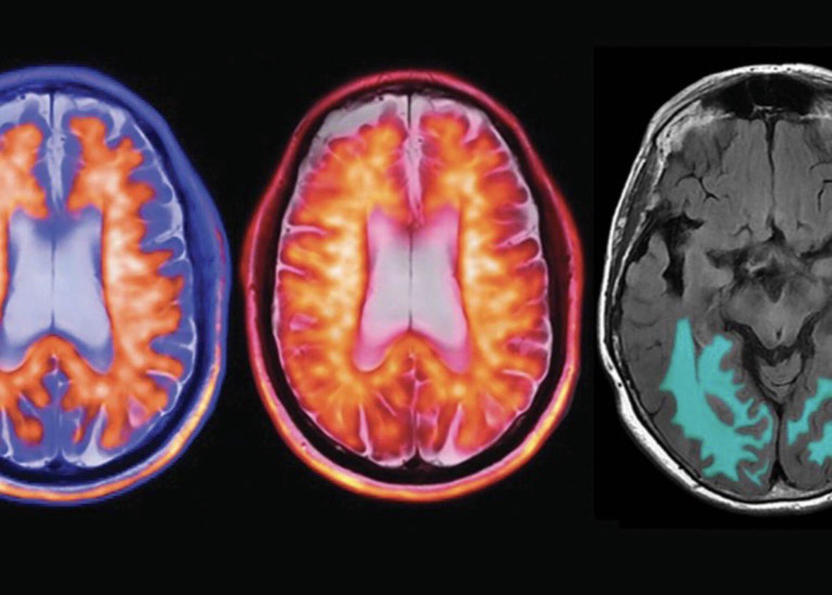 LRsecreta's tweet image. Un tratamiento con ultrasonido 'restaura' la mente de un paciente de alzhéimer en China 🇨🇳

El neurólogo Sun Bomin afirma que los síntomas de alzhéimer mejoran tras un procedimiento de ultrasonido focalizado de alta intensidad

👉 …noticia esperanzadora ⛔️