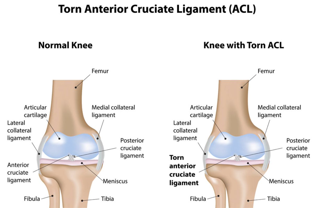 LASportsOrthoMD's tweet photo. Think #ACLtears are only for elite athletes? Think again. Recreational sports like skiing, basketball, or socer can cause #ACL injuries too. Sudden twists, pivots, or hyperextension with a planted foot can overload the ligament & lead to knee instability. https://t.co/CJPARVDCqv https://t.co/rdO0a9vAsA
