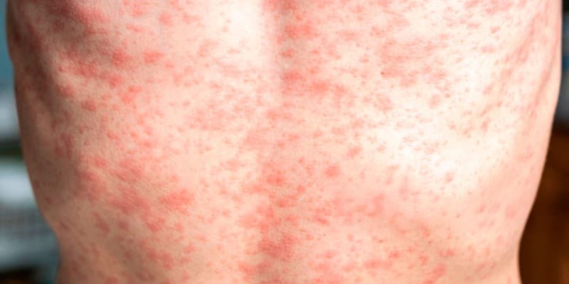 herqles_es's tweet image. 🇪🇸 | #Ampliación Según los datos de vigilancia epidemiológica del Instituto de Salud Carlos III, ninguno de los casos de sarampión reportados en 2025 tiene un origen autóctono. En 2024 la mayoría procedían de Marruecos o Rumania.