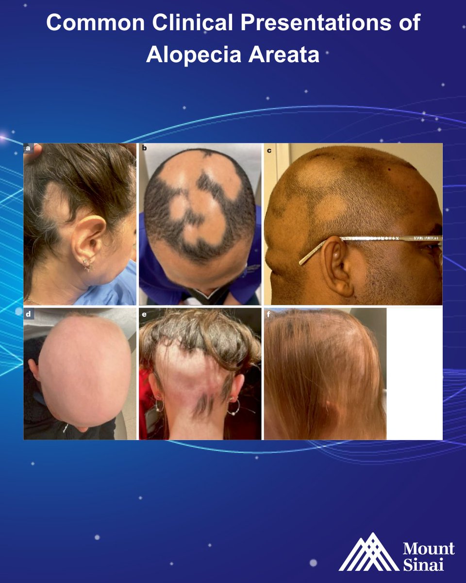 Mount Sinai Dermatology tweet media