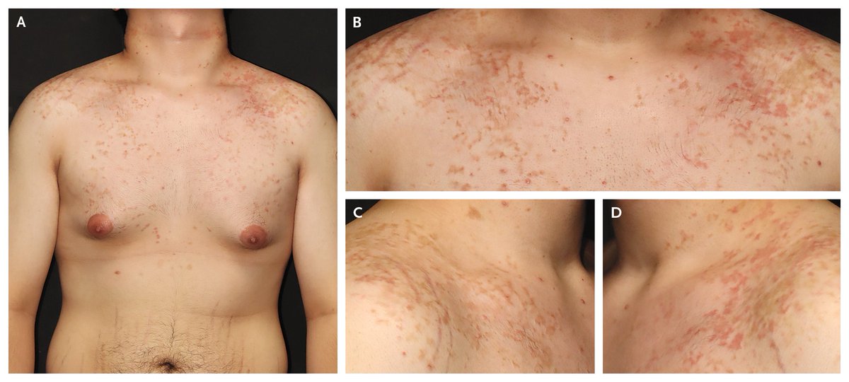 NEJM's tweet image. Images in Clinical Medicine: Prurigo Pigmentosa nej.md/3YPCxWk

#DermTwitter #Immunology