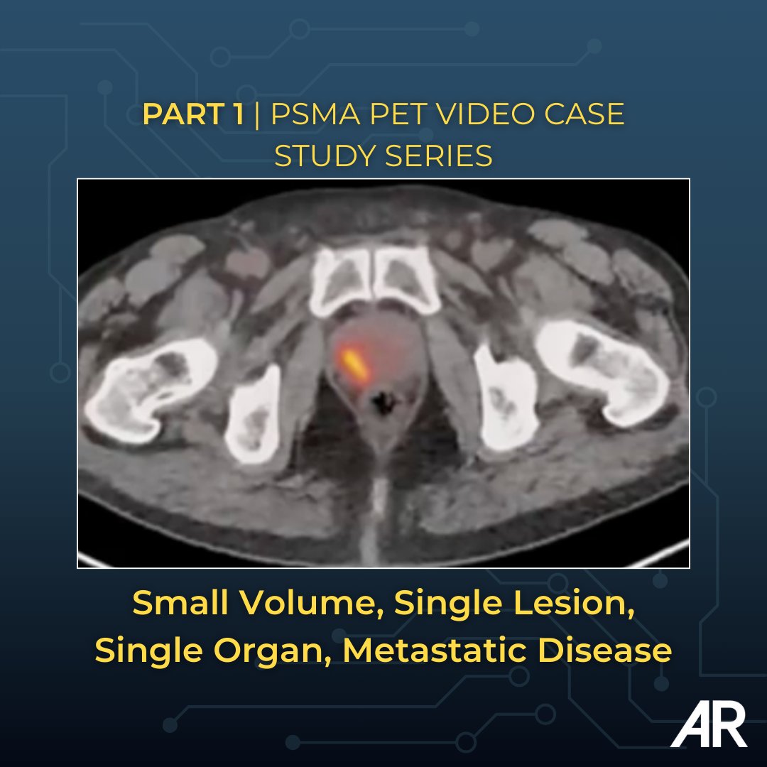 Applied_Rad's tweet photo. “One lesion can change everything.” In Part 1, Louis Mazzarelli, MD, explains how a single focus on PSMA PET may upstage disease and alter management strategy.

▶️ Watch Part 1 of the PSMA PET Video Case Study Series: https://t.co/ctnUHRCEzA 

#PSMAPET #Radiology #CaseSeries #ProstateCancer #MolecularImaging #PETCT #RadEd #MedEd