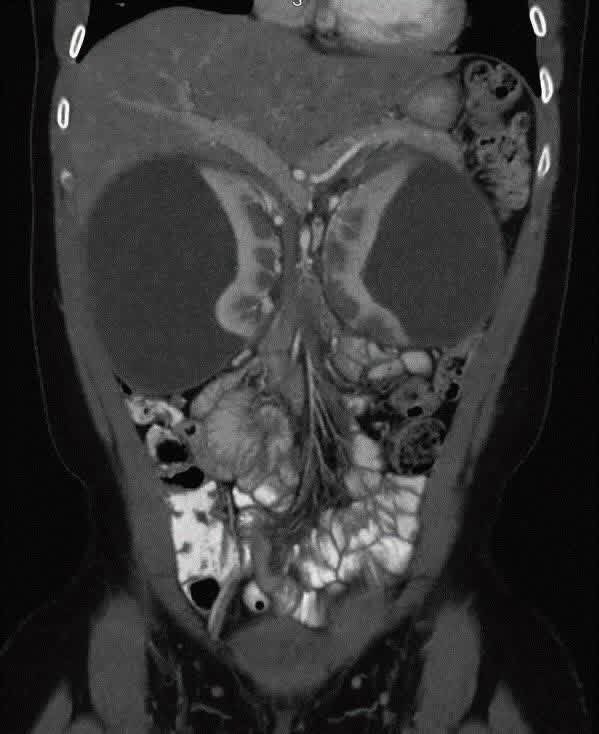hemo_shk's tweet photo. #Interesting_case
#Rare
A male patient presents with hypertension, flank discomfort, and oliguria. No history of trauma.
What is the most likely diagnosis?!
Radiological findings?!
#MedX #MedTwitter #MEDHM @IhabFathiSulima https://t.co/Hb7CLus7RK