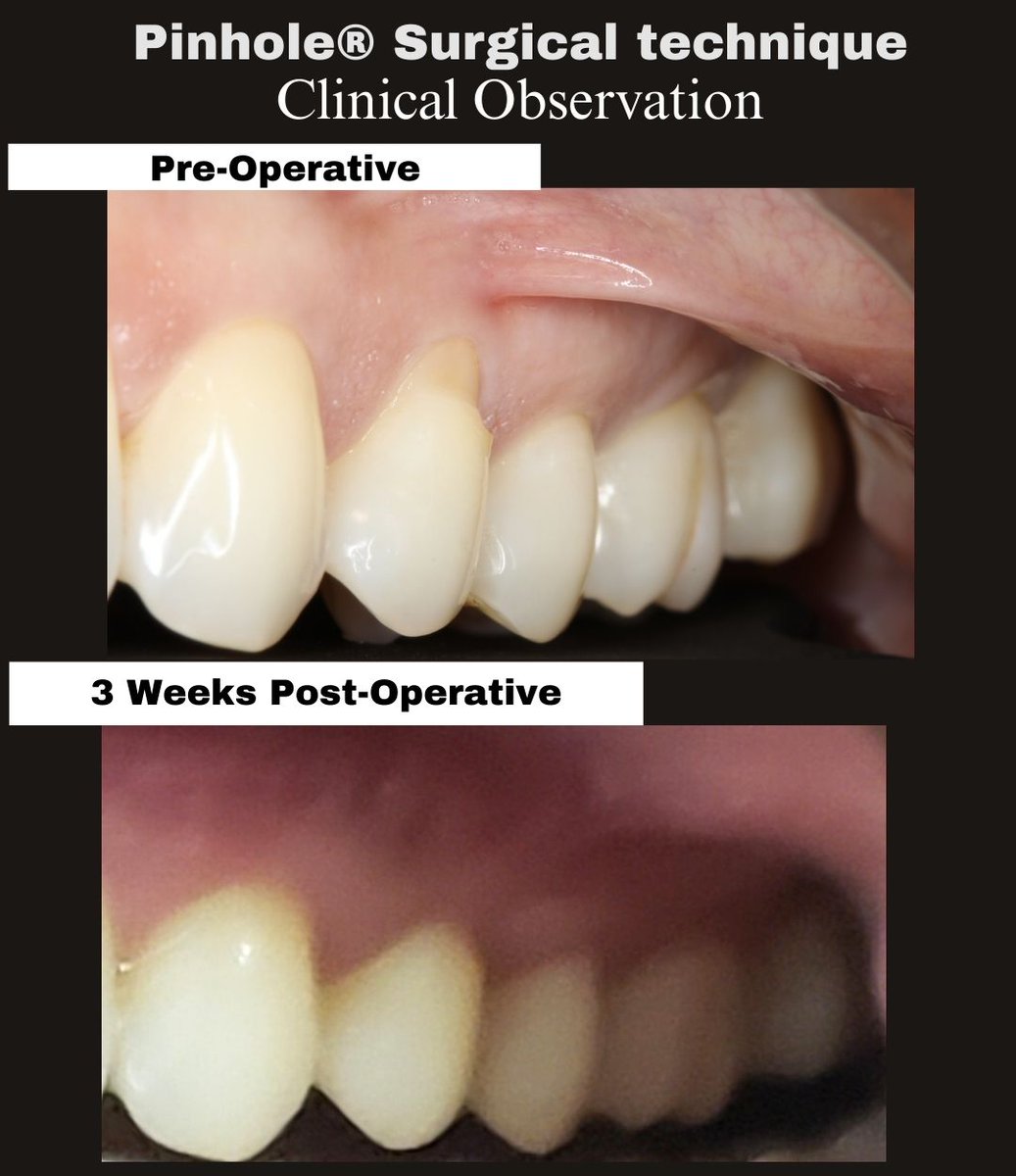 JohnChaodds's tweet photo. 3 weeks post-op (#5–12). Early coronal positioning with increased tissue thickness.  #pinholesurgicaltechnique #gumrecession https://t.co/yXa0PgJ4oj