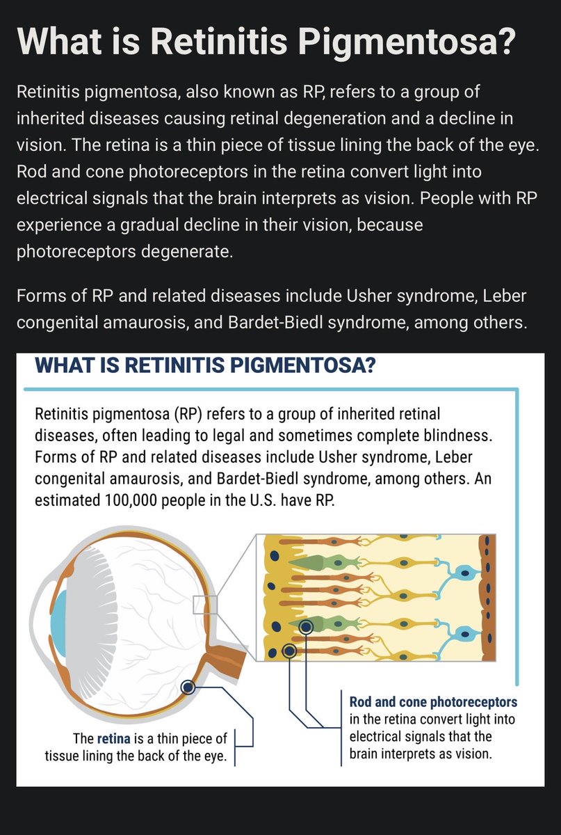 BRexNew's tweet photo. #MAHA #MakeAmericaSeeAgain 31 years since #retinitispigmentosa diagnosis
Nancy is experiencing change through treatment in the #OCU400 trial #SeeTheFuture
She reports better definition, improved light adaptation, can read without a magnifier.
#OneAndDone #GeneTherapy $OCGN https://t.co/R2cMQxbQsB