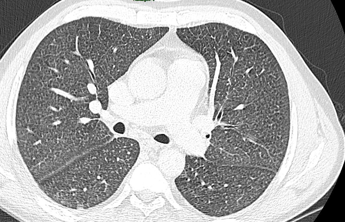 sofia_gambetta's tweet photo. 🫁 Challenging chest CT pattern
41-year-old male. Chronic kidney disease secondary to polycystic kidney disease

CT findings:
▫️ Innumerable miliary nodules
▫️ Bronchial + interlobular septal thickening
▫️ Isolated mediastinal lymphadenopathy
▫️ No pulmonary edema

📌 With no additional clinical information, applying a pattern-based approach, the main differentials are:

1️⃣ Miliary tuberculosis
2️⃣ Hypersensitivity pneumonitis
3️⃣ Sarcoidosis

#RadTwitter #RadRes #ChestImaging #MedEd