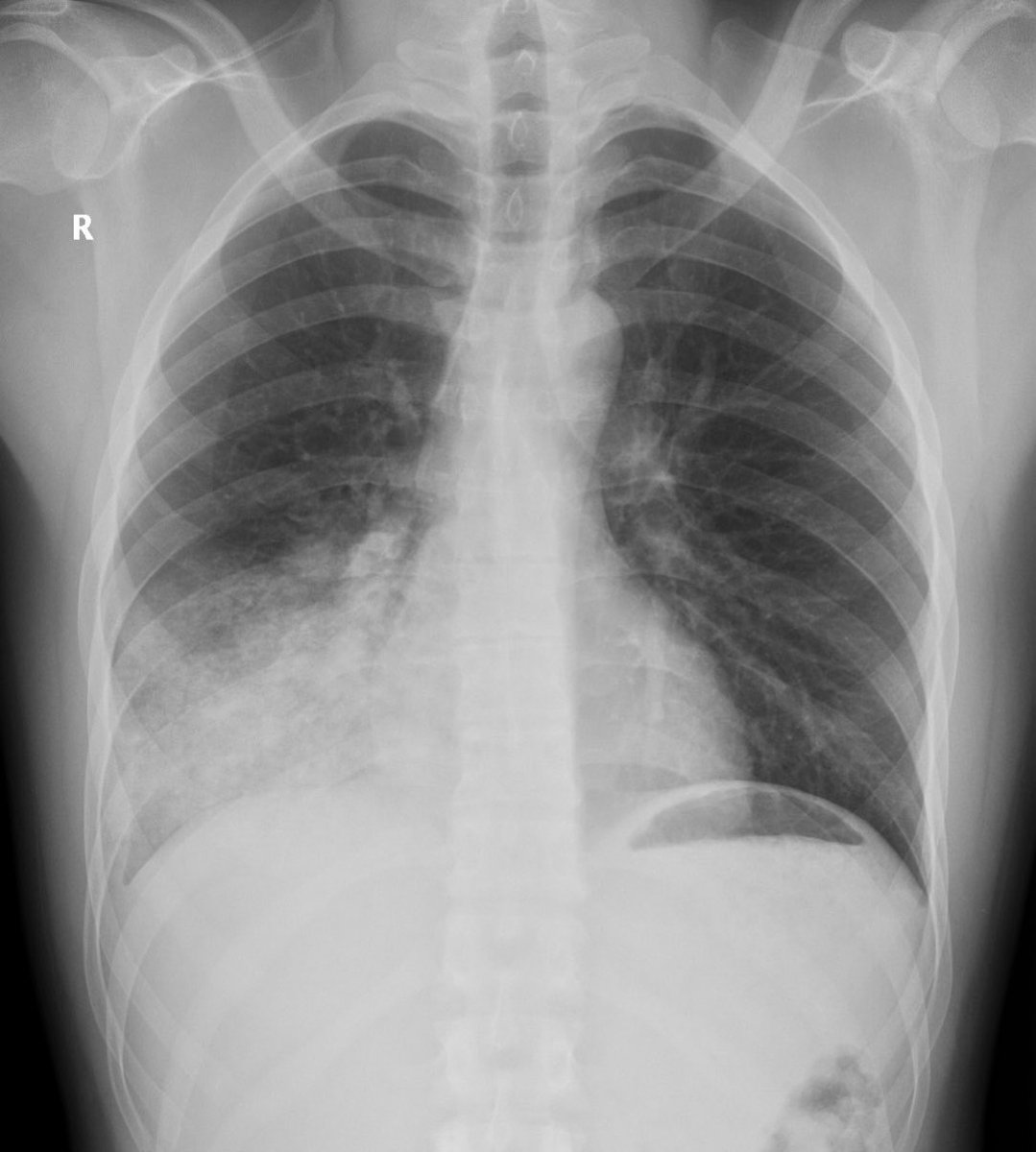 khaledzeid's tweet photo. Teaching case

A 22-year-old male presents with acute hemoptysis and a significant drop in hemoglobin.

Chest X-ray (PA view) shows right middle and lower zonal opacities.

📌 The appearance raises concern for focal pulmonary hemorrhage.

❓How would you approach this radiologically?

❓What are the main differential diagnoses for focal hemorrhage in a young patient?

(CT angiography was performed next.)