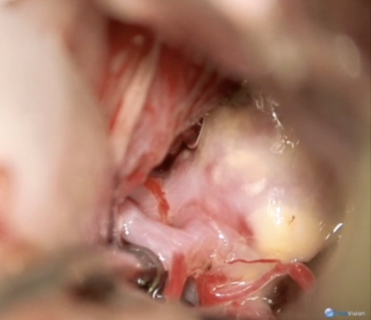 DrBaskaya's tweet photo. 🧠 AComA aneurysms: microsurgical clipping still offers superior long-term durability.
🔗 https://t.co/zeMMLaQvEY
#Neurosurgery #Cerebrovascular #Microsurgery #Neurovascular #Aneurysm https://t.co/0WY8TuJO3J