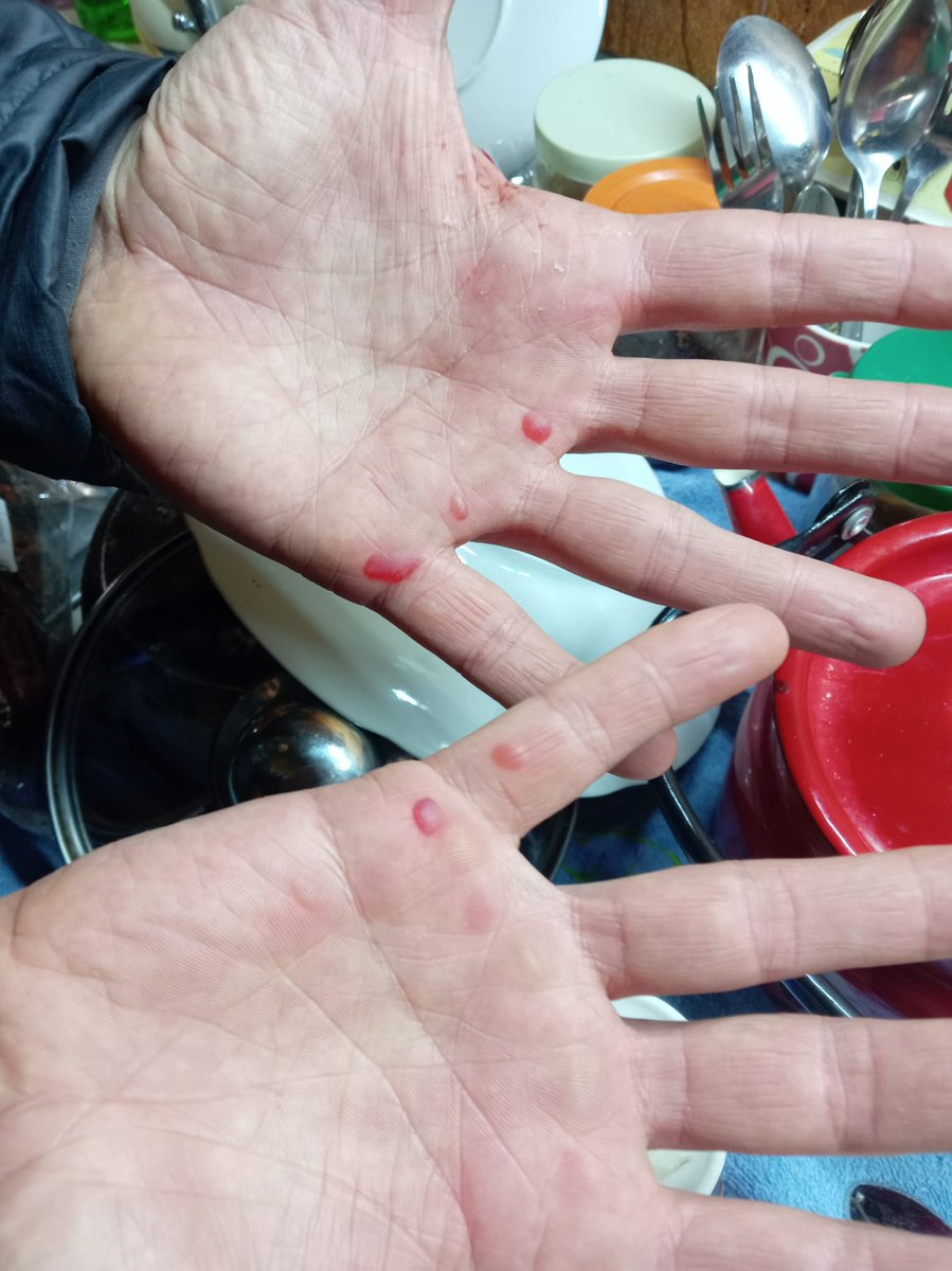 elm7r335's tweet image. Volunteer's log 
Wardate 1434.1/4361.1, вівторок
These are not from having your own private fun- you get these when you chop half a ton of candle material. Tools gave up in the battle, creatures of @coastoflife_od s StarShip TribbleRise didn't 💪🏼
Ukraine, live long and prosper 🇺🇦