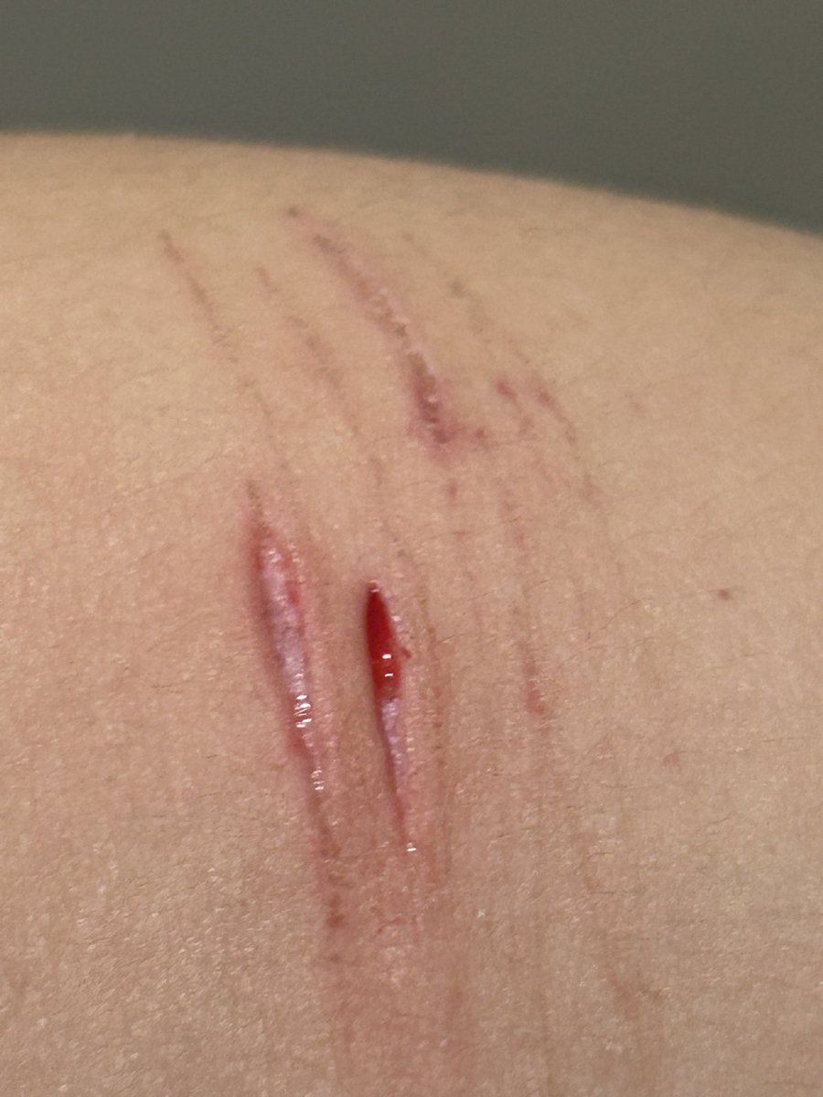 LikeToast40802's tweet photo. I went deeper as promised ≽(•⩊ •マ≼ , blood kept on filling up but there was a bean peeping out in the middle  (˶˃ ᵕ ˂˶) #shtwt #littlebeans #slicetwt #cuttwt https://t.co/vuEaEXErFH