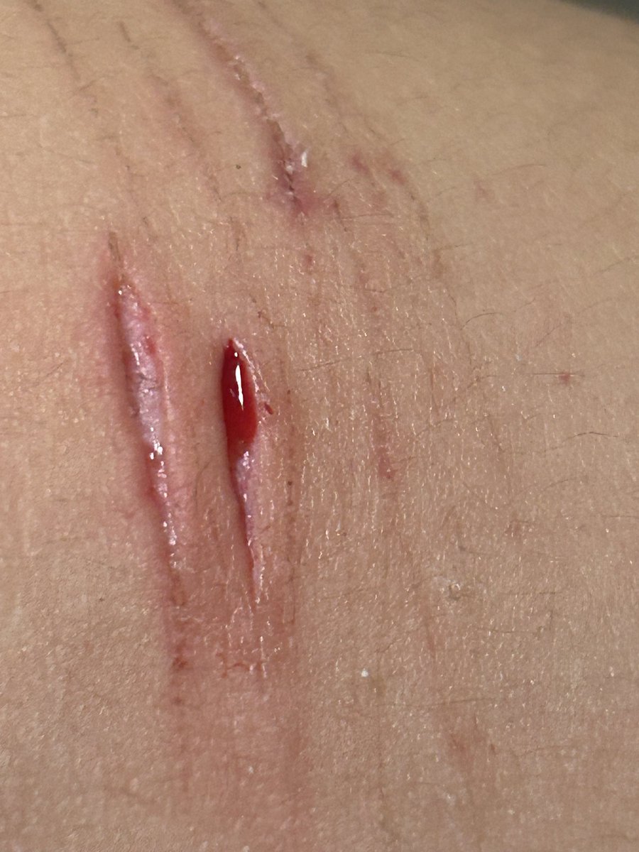 LikeToast40802's tweet photo. I went deeper as promised ≽(•⩊ •マ≼ , blood kept on filling up but there was a bean peeping out in the middle  (˶˃ ᵕ ˂˶) #shtwt #littlebeans #slicetwt #cuttwt https://t.co/vuEaEXErFH