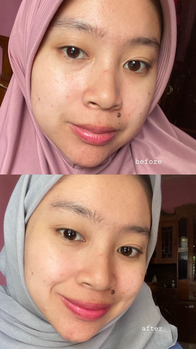 Guys! aku mau review jujur, cleanser korea favoritku nih! 🤩

kulit aku jadi halus dan lembap, nggak gampang rewel, ini kondisi sebelum vs sesudah pakai 🫶🏻

Aku spill cleansernya di bawah ini👇