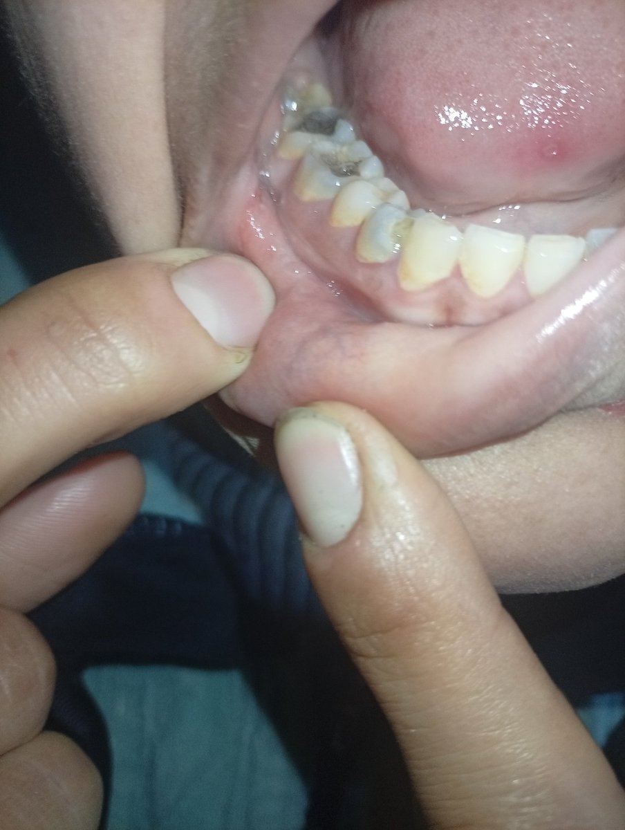 sajafromGaza's tweet photo. I swear I'm so tired... My toothache is killing me and I can't sleep or live normally.
I'm not asking for the impossible, just help so I can get treatment.

Whoever can donate or even share this, may God reward them abundantly.
I received one hundred out of four hundred dollars. Please help me. 🙏

https://t.co/7lYuh6vmoX

@ireallyhateyou @buffetbreaker @corpseinorbit @goldenintifada @KurosCharney  @EPM106 @_krispy_karim_ @strike_dr @PetreRaleigh @_VivaPalestina_ @PixieOfDeath @Elmsington @mrs_socialista @honeydijon13 @AlisonGeorge10 @burak_turna  @hernandy_s @thelilmosquito @pet_wife @matthewjswalker @EisakuOtomo @judeinlondon @Arbeitologist @Shepherds4Good @emopunkgrrrl @meralhece @erdtrees @staticbluebat  @UdsiAsli @singingsox @soulkhan @Alper_TeMuRi_   @MetaReflexive