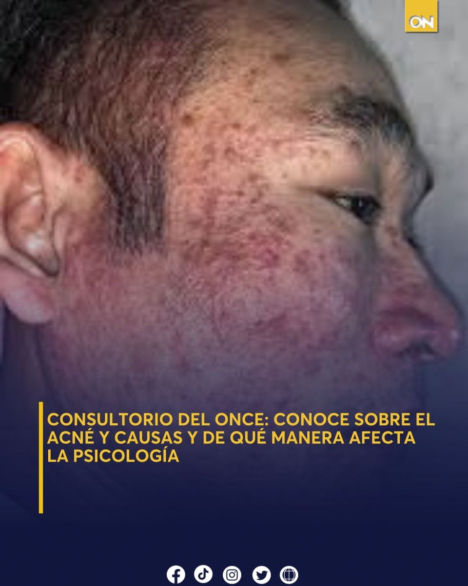 canal11hn's tweet image. El acné no es solo un tema estético, afecta profundamente la salud mental y la autoestima. 🩺 Conozca sus causas y el impacto psicológico en nuestro Consultorio del Once. 👇 oncenoticias.hn/on/consultorio…
#Acne #causas #Psiologia