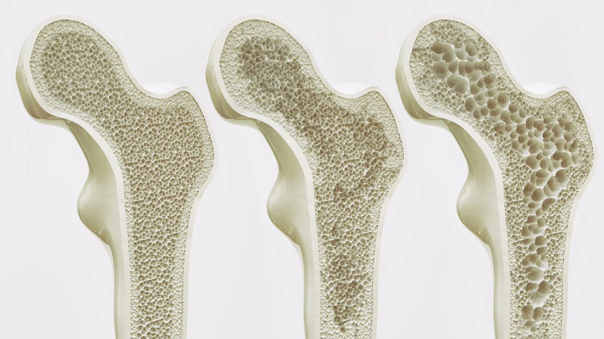 USAMedRes's tweet image. 1/  Identified a biological mechanism that explains how physical activity helps maintain strong bones. This discovery may lead to treatments for osteoporosis and bone loss, particularly in individuals unable to exercise.
