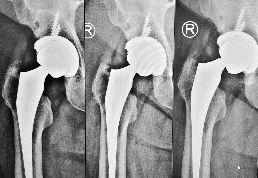 centerofhip's tweet image. Diagnosis? THR done 14 years ago. Presents with right groin pain for 2 years. X rays are a year apart
What's the problem? 
What next? 
#orthotwitter
 #orthoX