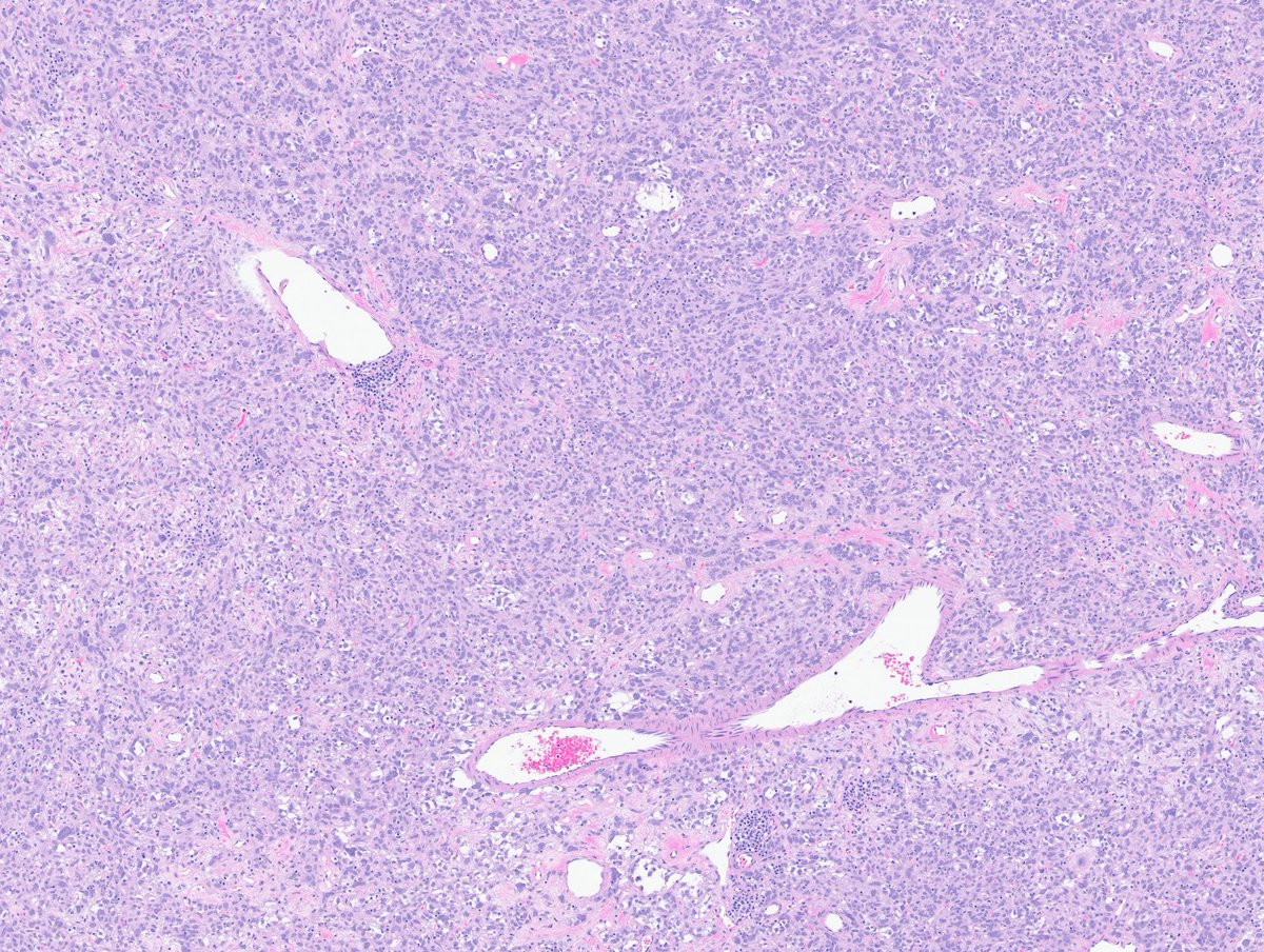 Greg_Charville's tweet image. A very vascular tumor indeed - however the neoplastic cells are not endothelial. Here's a better look at another part of the same tumor: