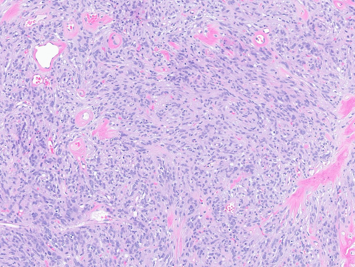 Greg_Charville's tweet image. A very vascular tumor indeed - however the neoplastic cells are not endothelial. Here's a better look at another part of the same tumor: