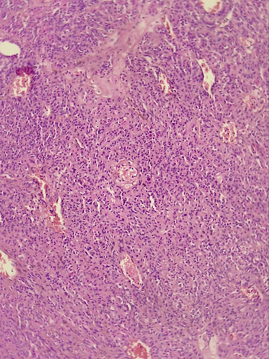 megha_lalcheta's tweet image. 34/F, #Parotid mass!!! 
#EndoPath 

Diagnosis?

#PathX #Pathology #PathResidents #Surgpath #Pathtwitter #Pathologists