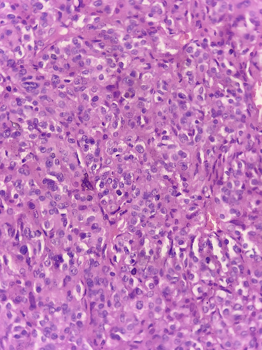 megha_lalcheta's tweet image. 34/F, #Parotid mass!!! 
#EndoPath 

Diagnosis?

#PathX #Pathology #PathResidents #Surgpath #Pathtwitter #Pathologists