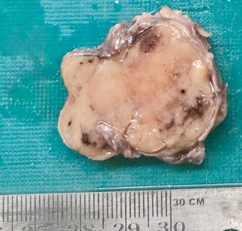 megha_lalcheta's tweet image. 34/F, #Parotid mass!!! 
#EndoPath 

Diagnosis?

#PathX #Pathology #PathResidents #Surgpath #Pathtwitter #Pathologists