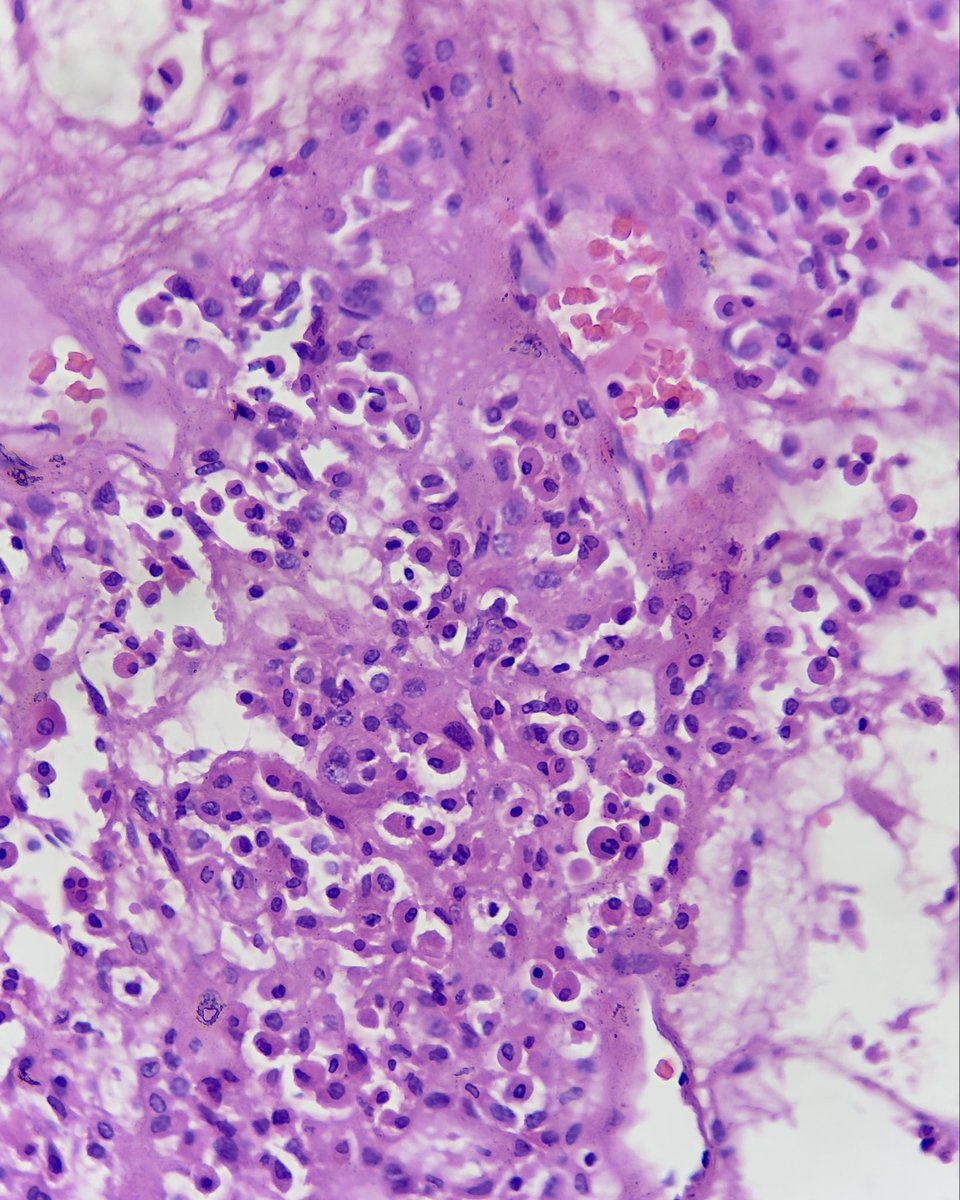 megha_lalcheta's tweet image. Few more microscopic images….. 
suggested ihc markers? 

#Parotid mass #EndoPath #PathX #Pathology