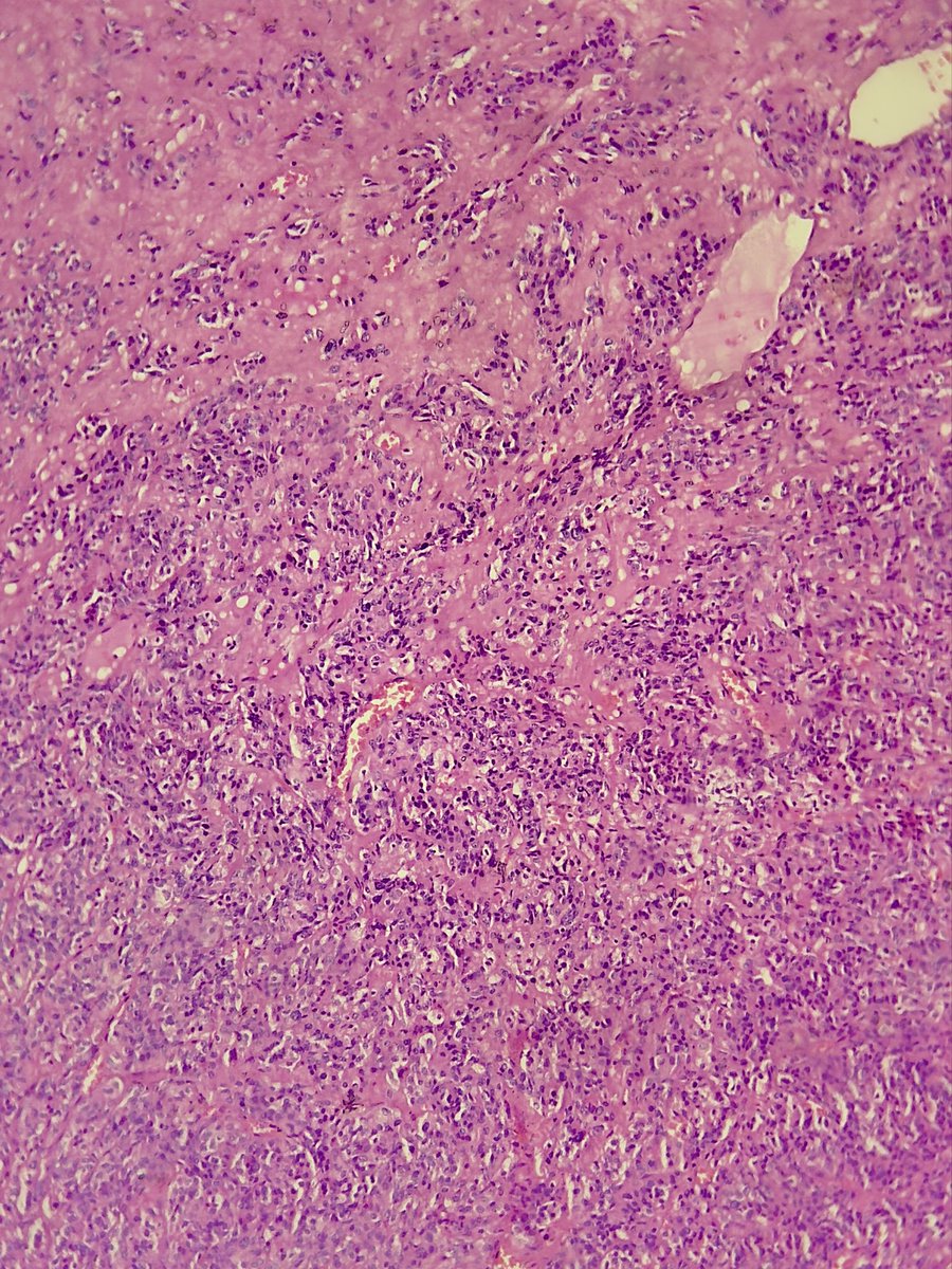 megha_lalcheta's tweet image. Few more microscopic images….. 
suggested ihc markers? 

#Parotid mass #EndoPath #PathX #Pathology