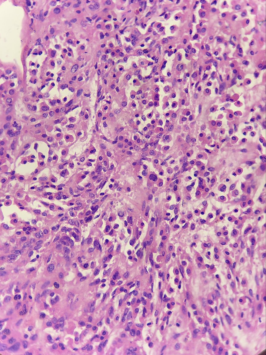 megha_lalcheta's tweet image. Few more microscopic images….. 
suggested ihc markers? 

#Parotid mass #EndoPath #PathX #Pathology