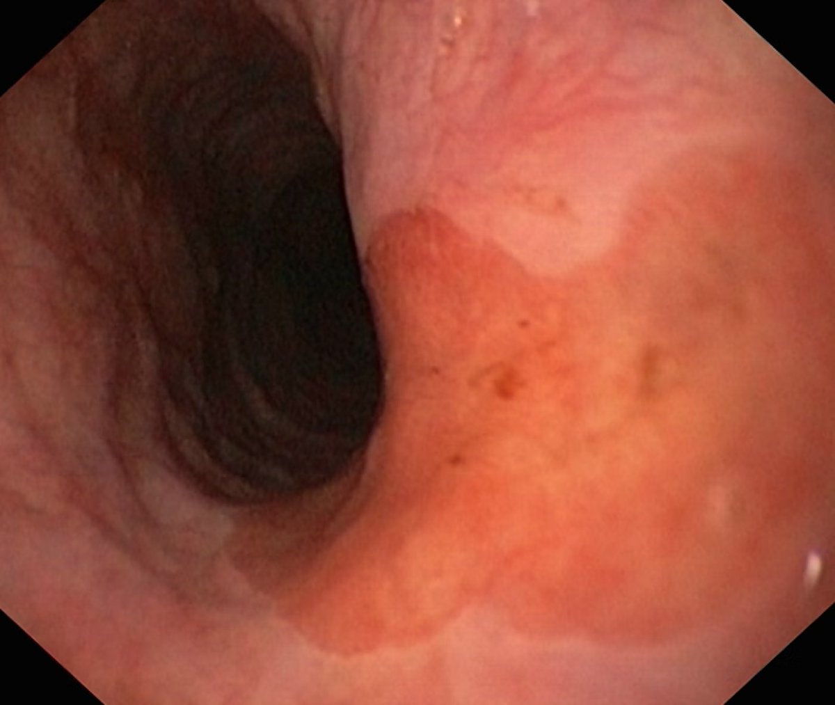 EndoCollab™ | GI Endoscopy Community tweet media