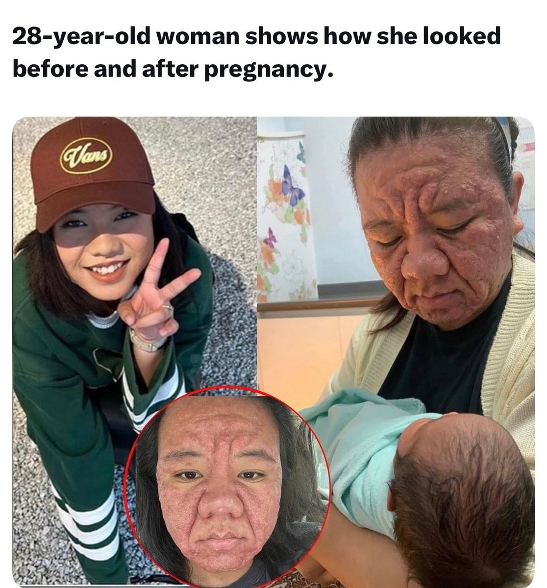 Pregnancy depletes nutrients.

The big inflamed looking nose might be due to a b-vitamin deficiency (riboflavin iirc). Happens to alcoholic men as well.

In this case, whatever skin disease she was diagnosed with might’ve manifested due to a severe deficiency of vitamin C, which