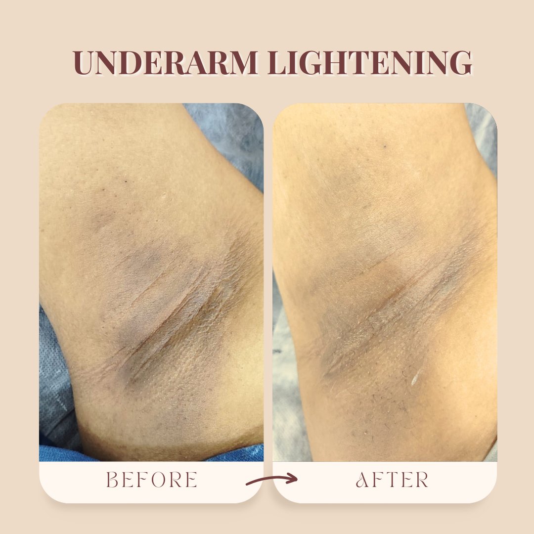 midaswellness9's tweet photo. Dark underarms aren’t permanent.
With the right medical treatment, even stubborn pigmentation fades.

Real results. Real skin.
Only at Midas Wellness Hub, Borivali.

Book your consultation today. https://t.co/CfPXKeftUE