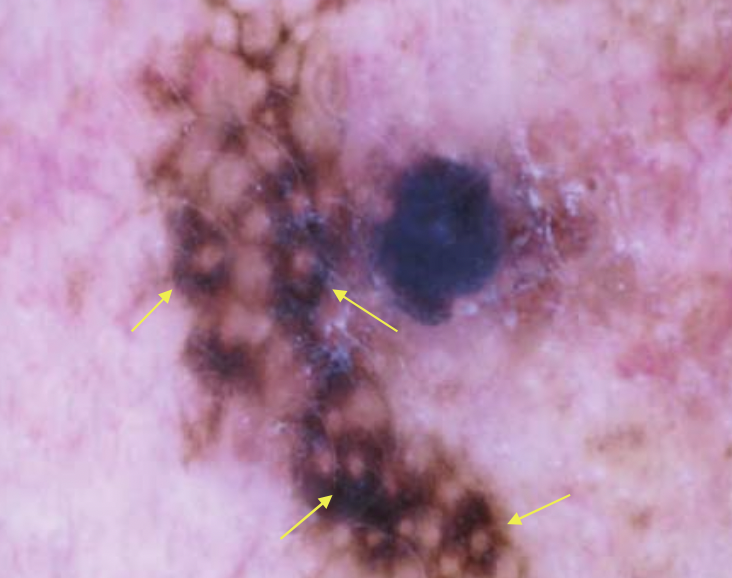 DermMarianne's tweet photo. 1⃣ Dermoscopic structure a day

🔷 Rhomboid structures
Black or brown pigmentation surrounding the entire follicular opening

Seen classically in lentigo maligna 

#dailyscope https://t.co/fDgnTQzNFq