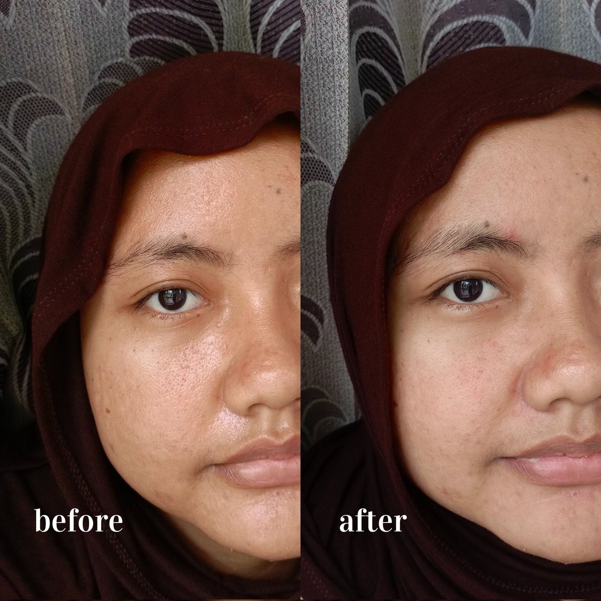 after rutin pake ini…
🎀 kulit lebih calm
🎀 bruntusan pelan-pelan bye
🎀 minyak nda over
before–after keliatan banget muka lebih fresh &amp; glowing natural ✨💭
sensitif girlies pasti suka 🫶
