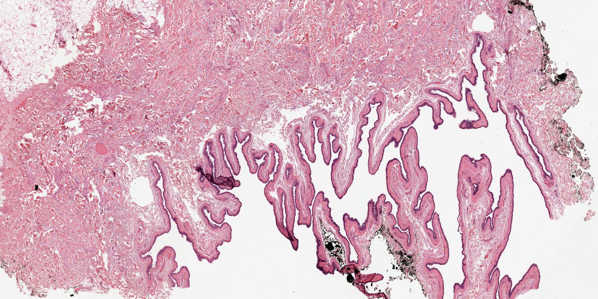 DrCycloPath's tweet photo. #TooFarToDiagnose? 🧐
Cystic lesion.
A. Cutaneous Ciliated Cyst
B. Cutaneous Endometriosis
C. Apocrine Hydrocystoma
D. Steatocystoma
#Pathology #BSTPath #Dermatology #DermPath https://t.co/BNDWgwbzCi