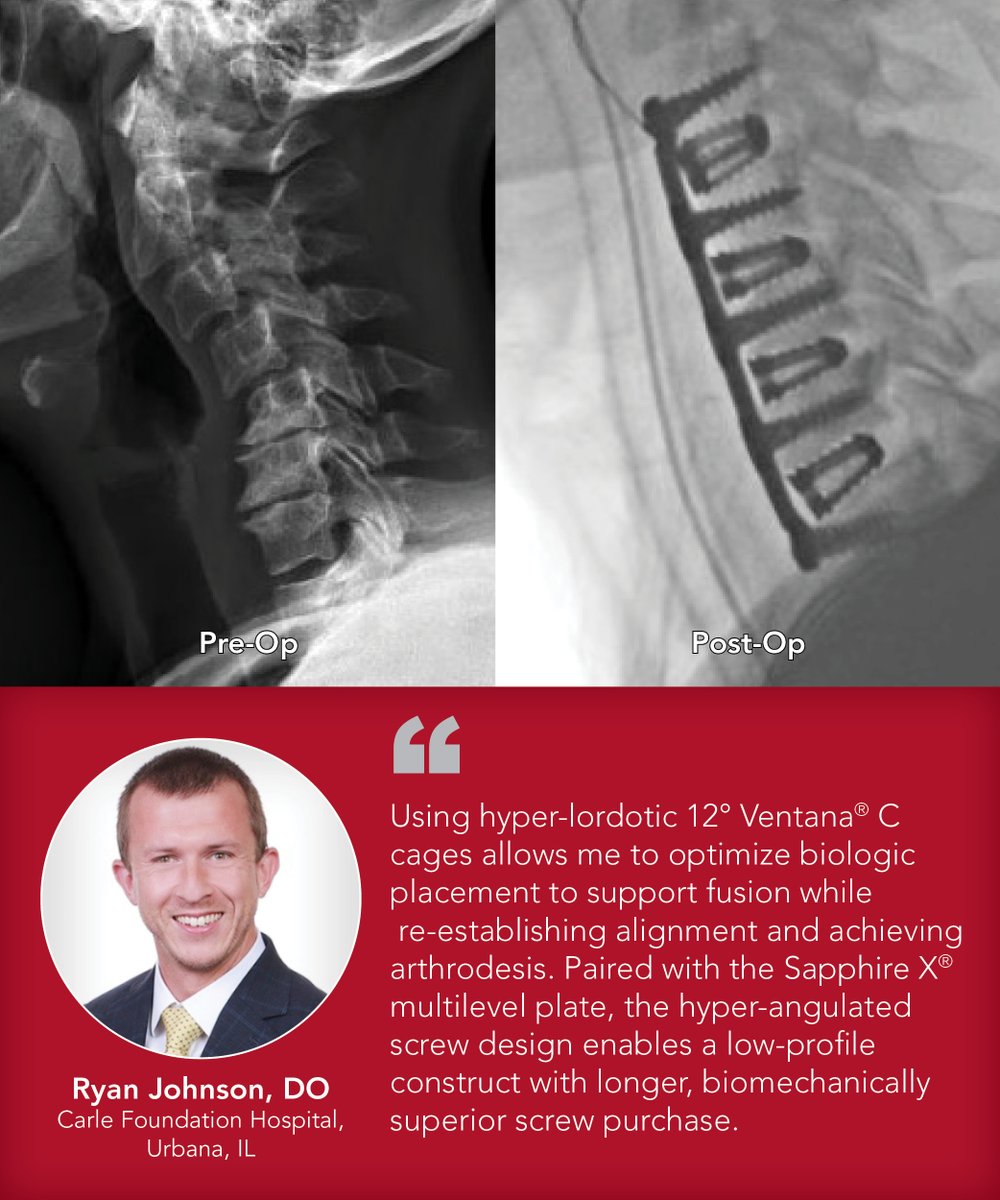 Spinal Elements tweet media