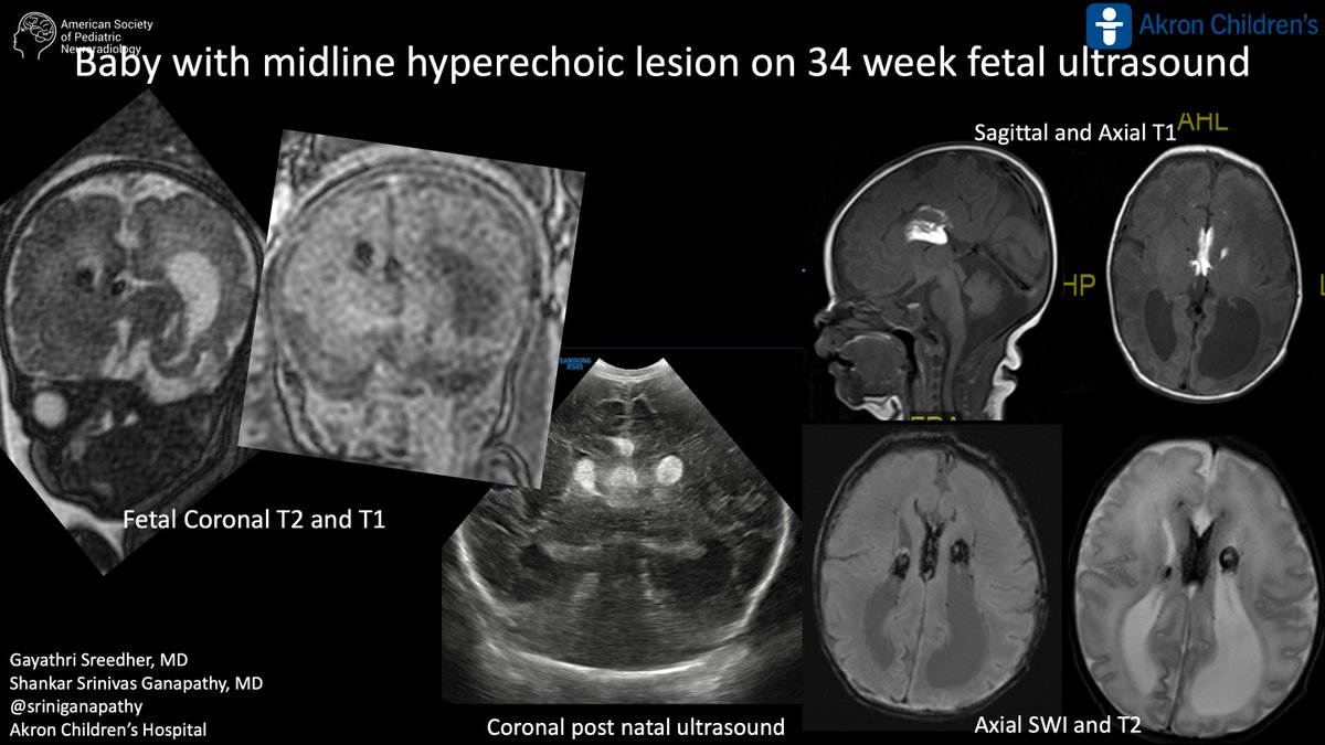 American Society of Pediatric Neuroradiology tweet media