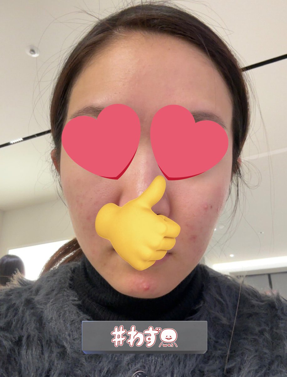 dead_or_gambaru's tweet photo. ✍🏻オンダリフトレポ
📍オルタクリニック
📝LDM6分+オンダリフト30kj

クリニックは混んでたけど、次の予定を伝えたら優先的に施術してくれて神！LDMで鎮静、オンダリフトはフェイスラインというよりは頬とかの脂肪周りを中心にやってもらって、after（3枚目）4日後だけど腫れもない！今後が楽しみ！！ https://t.co/pZ5Tl3HFeq