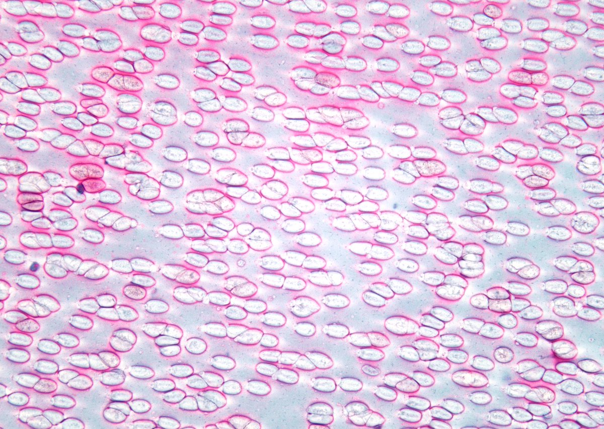 sza_jhcyto's tweet photo. "School of Fish". Colloid in a benign thyroid FNA. https://t.co/T2yCvjjaJ9