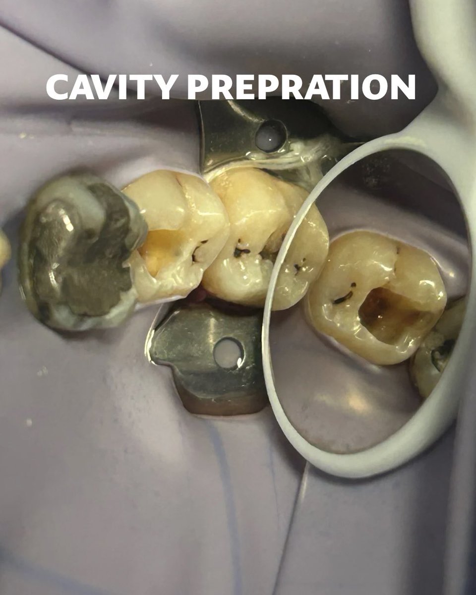Core buildup performed on tooth #47 using MTA and glass ionomer, restoration finalized with composite resin 🪄
