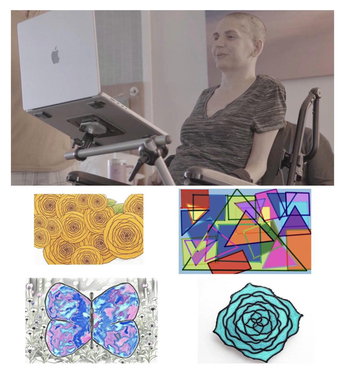 Audrey, paralyzed for nearly two decades, is now making abstract art through Neuralink Telepathy, just by thinking. ❤️
