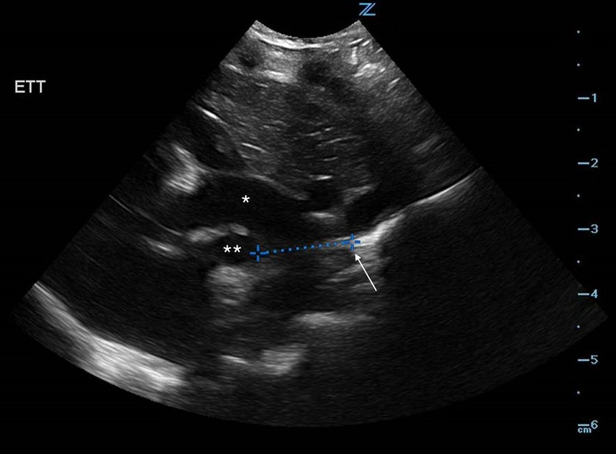 Are the days of endotracheal tube confirmation with x-rays going to become a distant memory?

POCUS showed sensitivity of 93% &amp; specificity of 59%, with AUC curve of 92%. Tracheal placement confirmed in 99%, &amp; esophageal misplacement in 4%
pubmed.ncbi.nlm.nih.gov/41261147/
#neotwitter