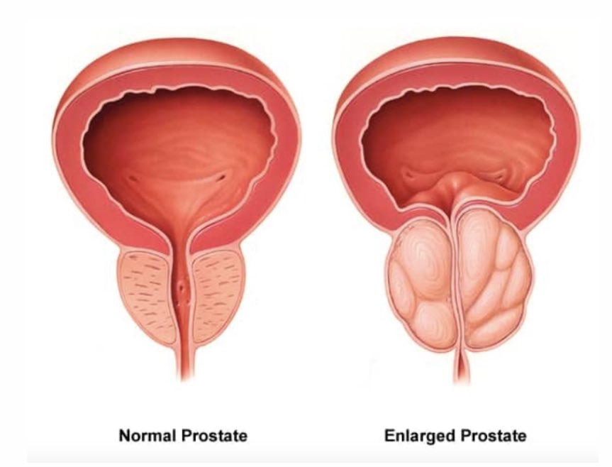zizelle_'s tweet photo. As men get older they begin to experience issues with their prostate gland.

For some, it is driven by genetics and lifestyle.
For others, it’s simply age doing what it does.

The big question is:

Can prostate enlargement be prevented?

What are the treatment options if it happens?