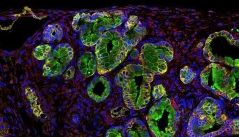 🔴 | El científico español Mariano Barbacid y su equipo han logrado eliminar el tipo más común de cáncer de páncreas en modelos animales.

Por primera vez se alcanza una curación completa en modelos experimentales.
«Pusimos tumores humanos en ratones y la combinación de fármacos