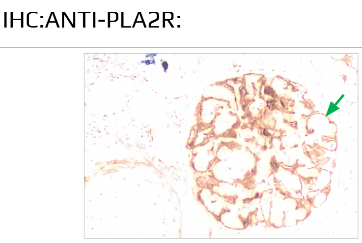 RadhikaDrpatil's tweet photo. #ECNeph@ISNeducation@isnkidneycare@myadla@drpradeeplotus@dilushiwijay
Anti-pla2R granular positivity seen along the capillary walls confirming as anti-pla2r mediated MGN https://t.co/4WEJK3owoY