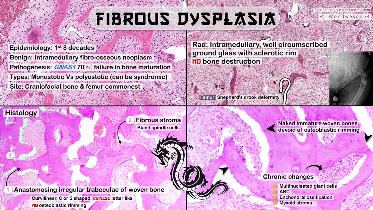 _Wondweson64's tweet photo. 🔬Diagnosis &amp; Annotated Pearls with DDx's | Previous case!
➤ FIBROUS DYSPLASIA
#Pathresidents #PathTwitter #BSTpath @Pathologists #pathX @AceMyPath @Pathology_mcqs https://t.co/rOvLSLhh3E